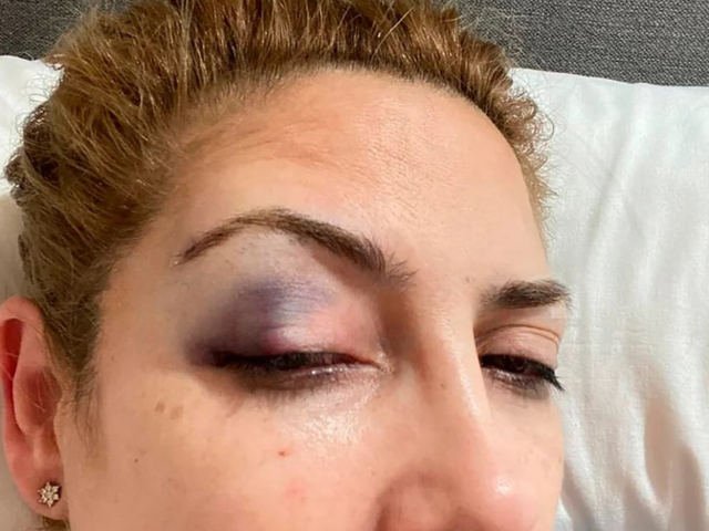 вЂњEse ojo morado existiГівЂќ: Fabiola YaГ±ez dio detalles de uno de los hechos de violencia por los que denunciГі a Alberto FernГЎndez