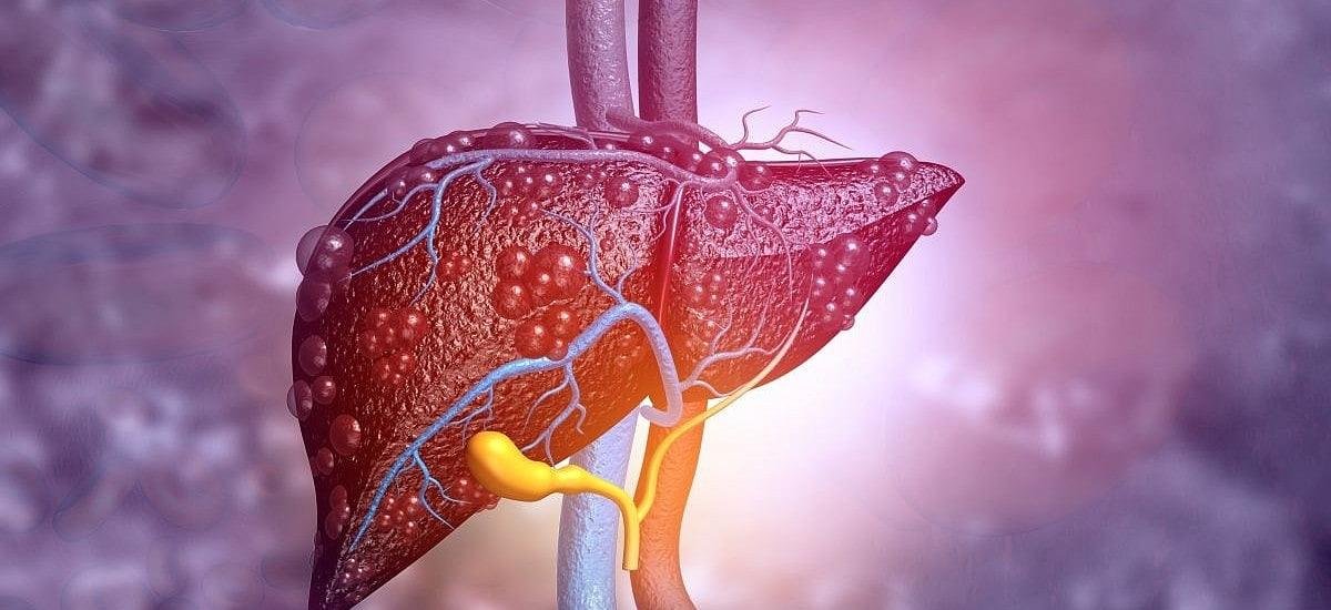 Análisis de sangre revela enfermedad hepática relacionada con el alcohol
