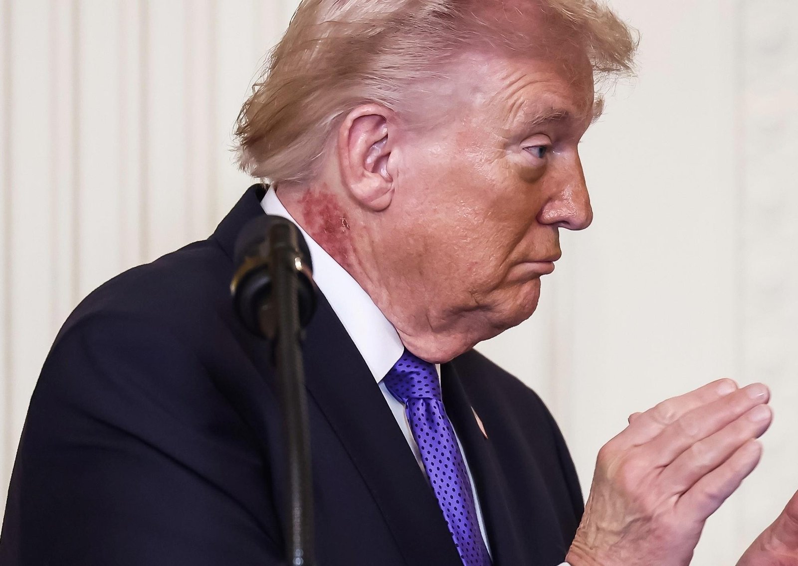 Trump apareció con un sarpullido rojo en el cuello: qué dijo su médico personal