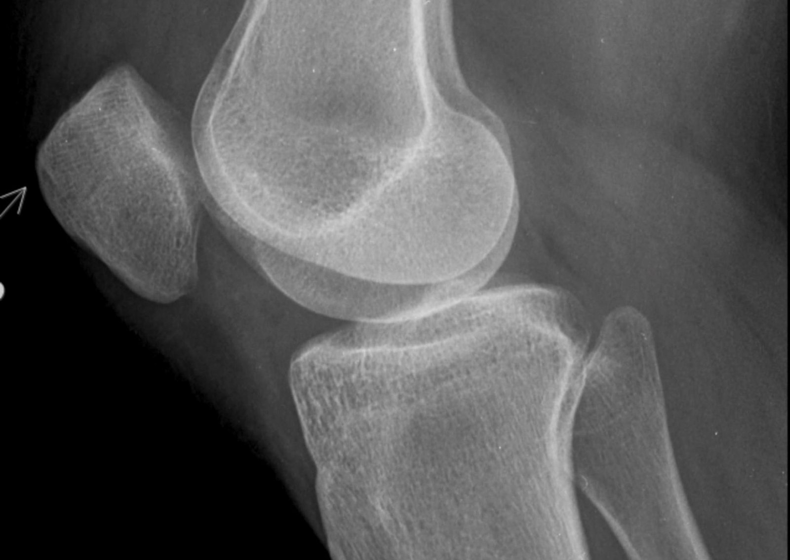 Qué alternativas hay para tratar la artrosis de rodilla y reducir el dolor