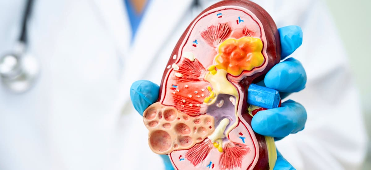 Prohibido por nutricionistas: estos son los tres alimentos de consumo diario que afectan a los riñones y nadie lo sabe