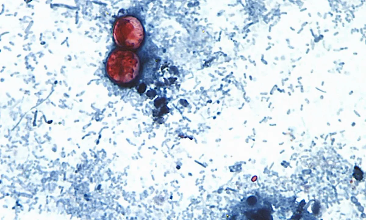 Funcionarios de EE.UU. vinculan brote de ciclosporiasis por lechuga a 3 estados más