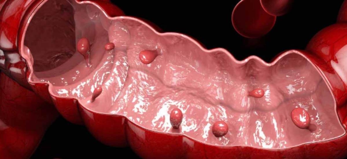 Cómo diagnosticar pólipos antes de que se convierta en cáncer de colón